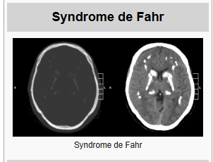 Maladie de Fahr Maladie de Fahr