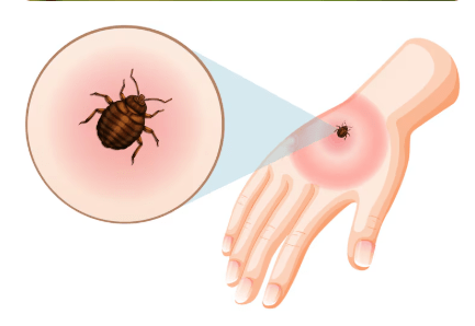 La maladie de Lyme 
