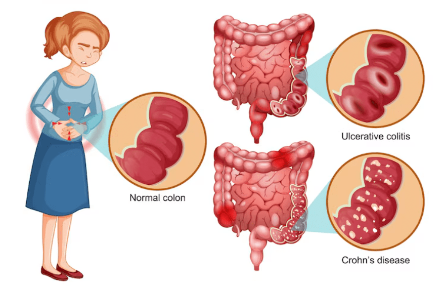 Celiac Maladie Celiac Maladie