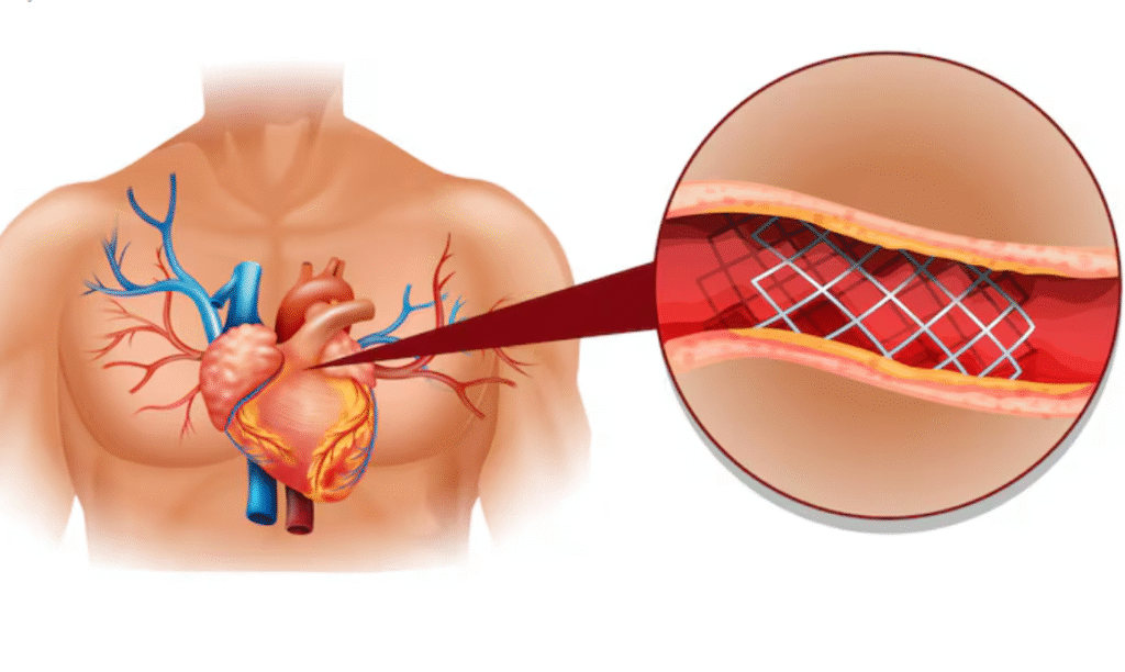 Maladie coronarienne